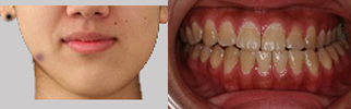 歯や顎が横にずれている場合の矯正治療